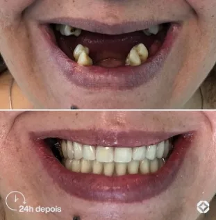 Boreli Impalantes - Antes e depois - implantes dentários - 02