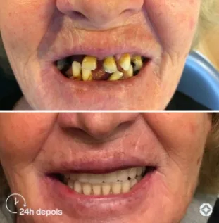 Boreli Impalantes - Antes e depois - implantes dentários - 07