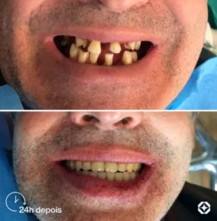 Boreli Impalantes - Antes e depois - implantes dentários - 09