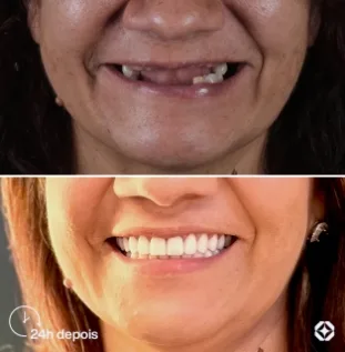 Boreli Impalantes - Antes e depois - implantes dentários