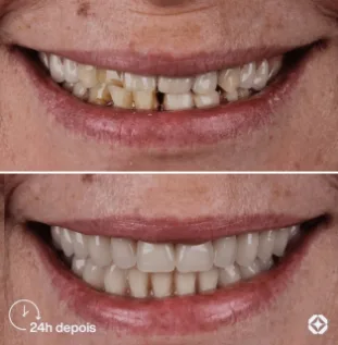 Boreli Impalantes - Antes e depois - implantes dentários - 10