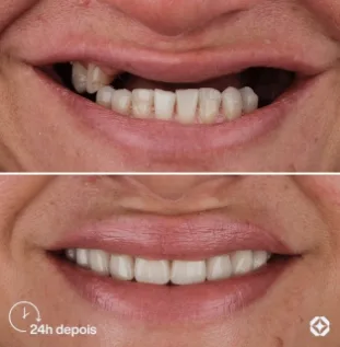 Boreli Impalantes - Antes e depois - implantes dentários - 13
