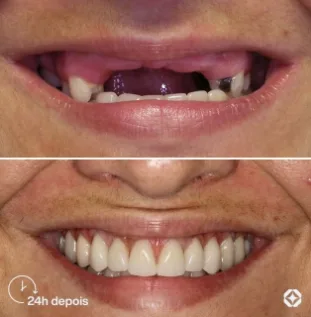 Boreli Impalantes - Antes e depois - implantes dentários - 14
