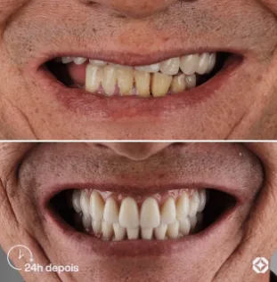 Boreli Impalantes - Antes e depois - implantes dentários - 15