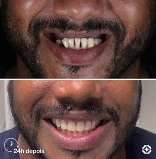 Boreli Impalantes - Antes e depois - implantes dentários