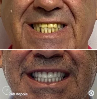 Boreli Impalantes - Antes e depois - implantes dentários