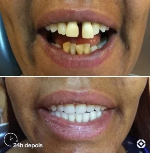 Boreli Impalantes - Antes e depois - implantes dentários