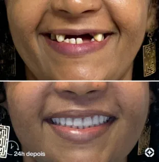 Boreli Impalantes - Antes e depois - implantes dentários