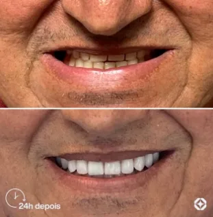 Boreli Impalantes - Antes e depois - implantes dentários