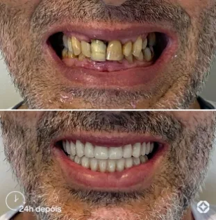 Boreli Impalantes - Antes e depois - implantes dentários