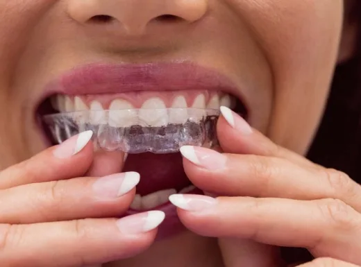 Borelli Implantes - Alinhador Transparente
