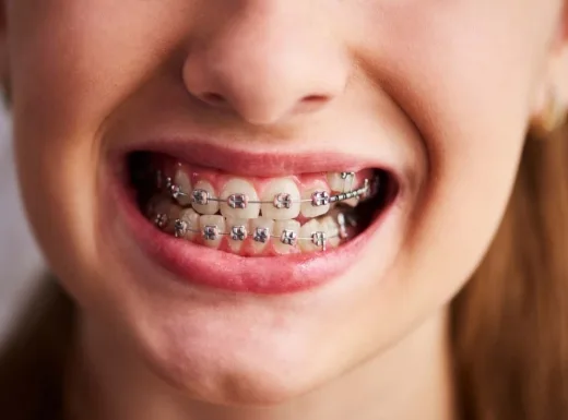 Borelli Implantes - Aparelho fixo