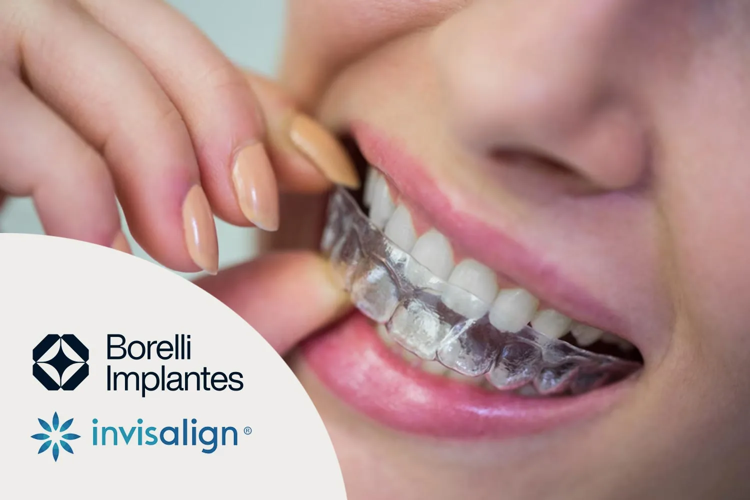 Borelli Implantes Aparelho móvel