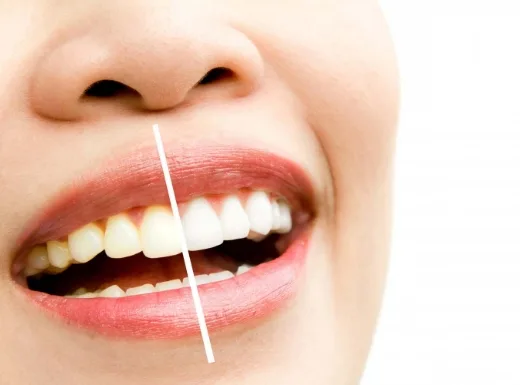 Borelli Implantes - Clareamento Caseiro