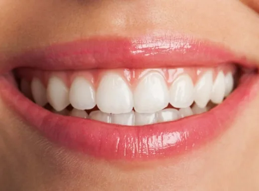 Borelli Implantes - Clareamento Consultorio