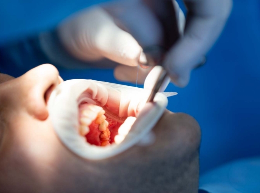Borelli Implantes - Extração dentária