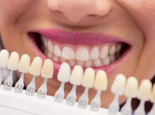 Borelli Implantes - Facetas Dentárias