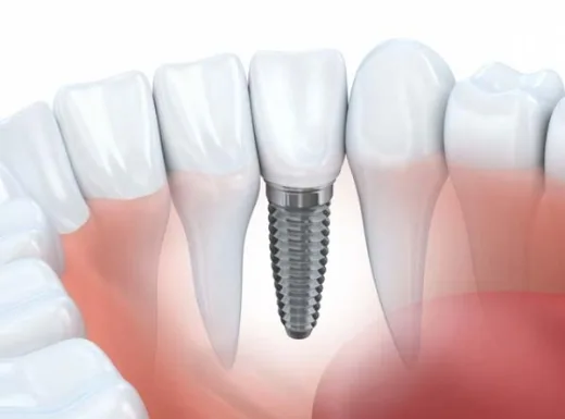 Borelli Implantes - Implante com carga imediata