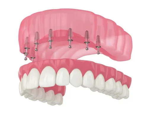 Borelli Implantes - Overdenture