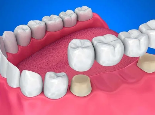 Borelli Implantes - Prótese Parcial Fixa