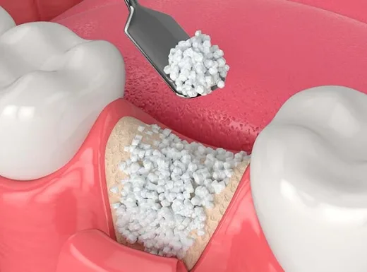 Borelli Implantes - enxerto-osseo