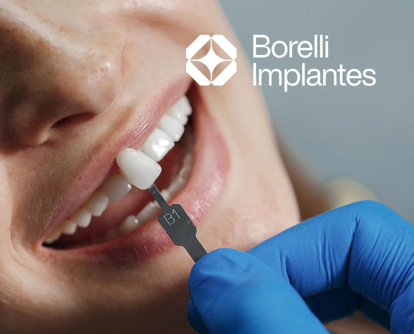 Borelli-Implantes-lentes-de-contato-dentes
